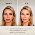 Frakcinio radiodažnio terapija (RF) - Vaizdas 2